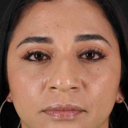 Rhinoplasty Before & After Patient #3082