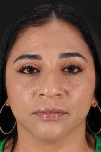 Rhinoplasty Before & After Patient #3082