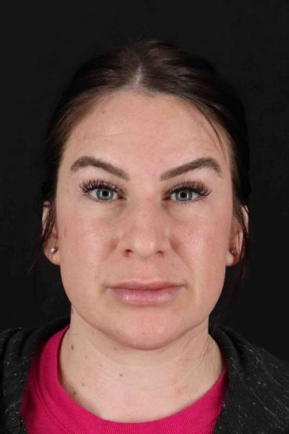Rhinoplasty Before & After Patient #3093
