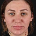 Rhinoplasty Before & After Patient #3104