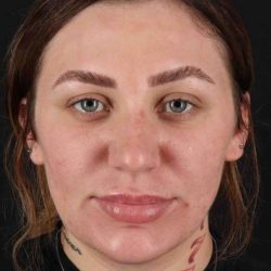 Rhinoplasty Before & After Patient #3104