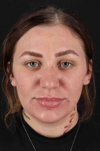 Rhinoplasty Before & After Patient #3104