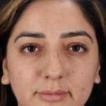Rhinoplasty Before & After Patient #3115