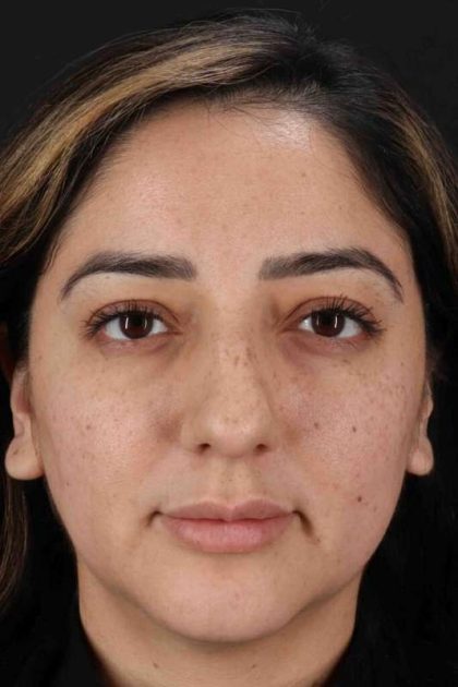 Rhinoplasty Before & After Patient #3115