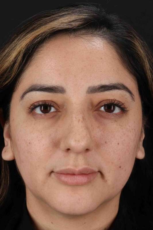 Rhinoplasty Before & After Patient #3115