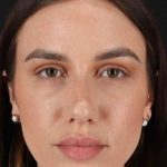 Rhinoplasty Before & After Patient #3137