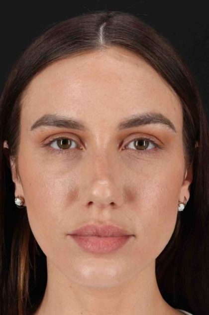 Rhinoplasty Before & After Patient #3137