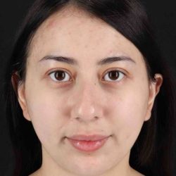 Rhinoplasty Before & After Patient #3159