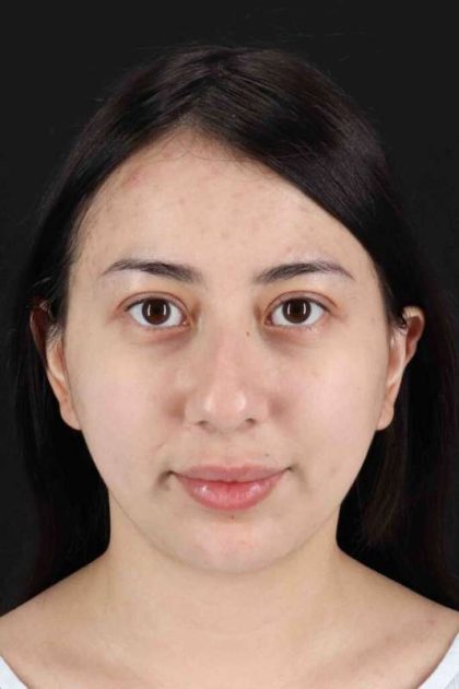 Rhinoplasty Before & After Patient #3159