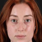 Rhinoplasty Before & After Patient #3170