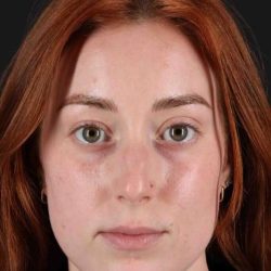 Rhinoplasty Before & After Patient #3170