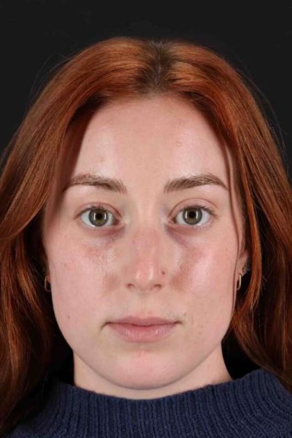 Rhinoplasty Before & After Patient #3170