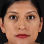 Rhinoplasty Before & After Patient #3181
