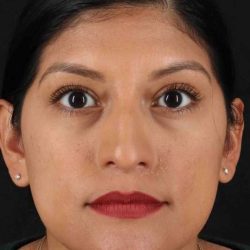 Rhinoplasty Before & After Patient #3181