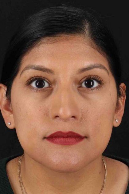 Rhinoplasty Before & After Patient #3181