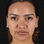 Rhinoplasty Before & After Patient #3192