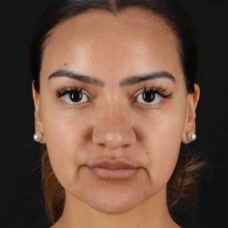 Rhinoplasty Before & After Patient #3192
