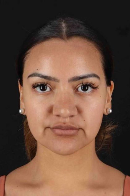 Rhinoplasty Before & After Patient #3192
