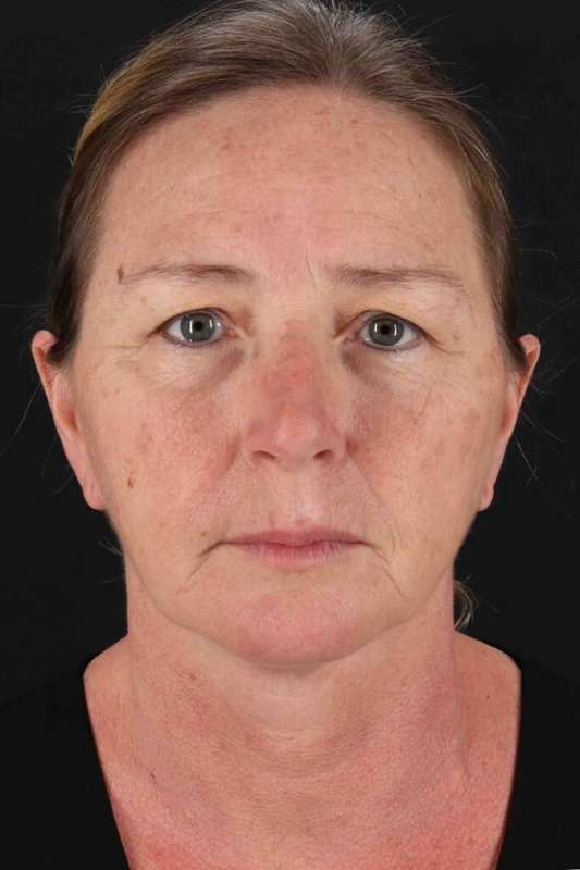 Rhinoplasty Before & After Patient #3203