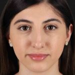 Rhinoplasty Before & After Patient #3214
