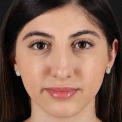 Rhinoplasty Before & After Patient #3214