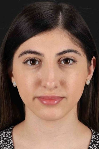 Rhinoplasty Before & After Patient #3214