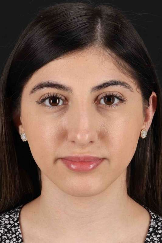 Rhinoplasty Before & After Patient #3214