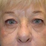 Browlift Before & After Patient #1414