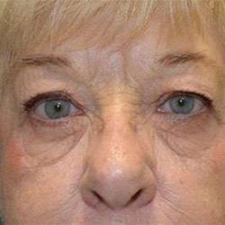 Browlift Before & After Patient #1414