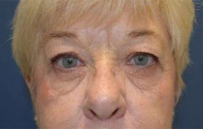 Browlift Before & After Patient #1414