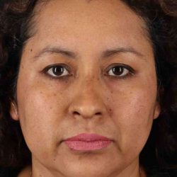 Rhinoplasty Before & After Patient #3225