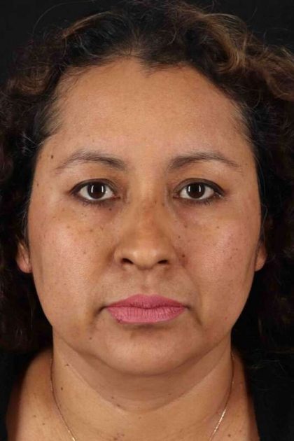 Rhinoplasty Before & After Patient #3225