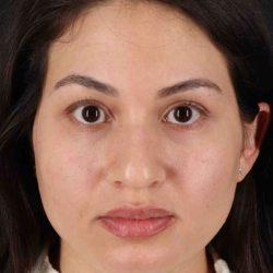 Rhinoplasty Before & After Patient #3236