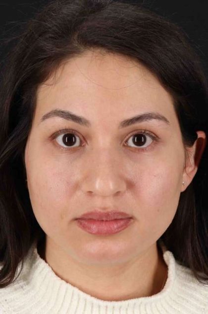 Rhinoplasty Before & After Patient #3236
