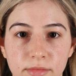 Rhinoplasty Before & After Patient #3247