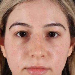 Rhinoplasty Before & After Patient #3247