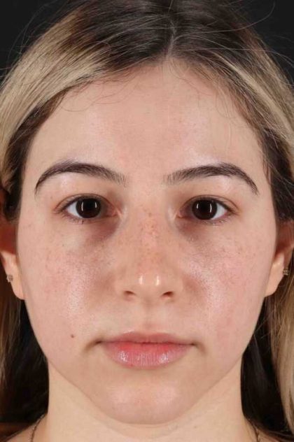 Rhinoplasty Before & After Patient #3247