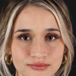Rhinoplasty Before & After Patient #3258