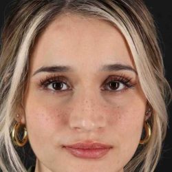 Rhinoplasty Before & After Patient #3258