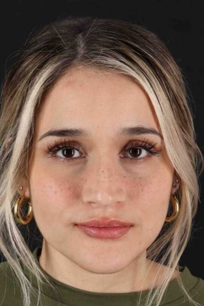 Rhinoplasty Before & After Patient #3258