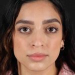 Rhinoplasty Before & After Patient #3269