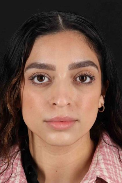 Rhinoplasty Before & After Patient #3269