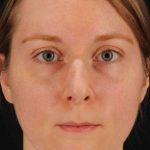 Rhinoplasty Before & After Patient #3280