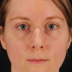 Rhinoplasty Before & After Patient #3280