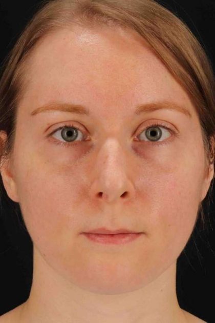 Rhinoplasty Before & After Patient #3280