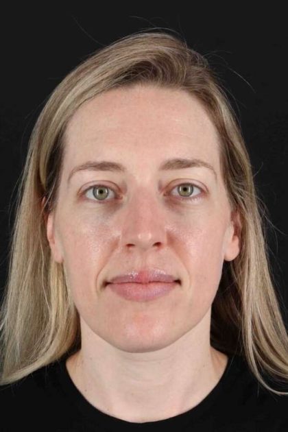 Rhinoplasty Before & After Patient #3291