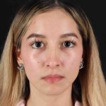 Rhinoplasty Before & After Patient #3302