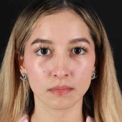 Rhinoplasty Before & After Patient #3302