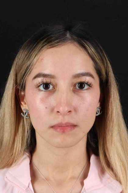 Rhinoplasty Before & After Patient #3302