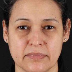 Rhinoplasty Before & After Patient #3313